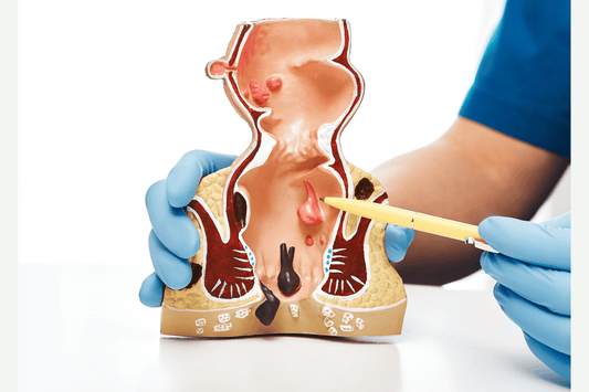 8 of the Best (and 2 of the Worst) Treatments for Hemorrhoid Relief