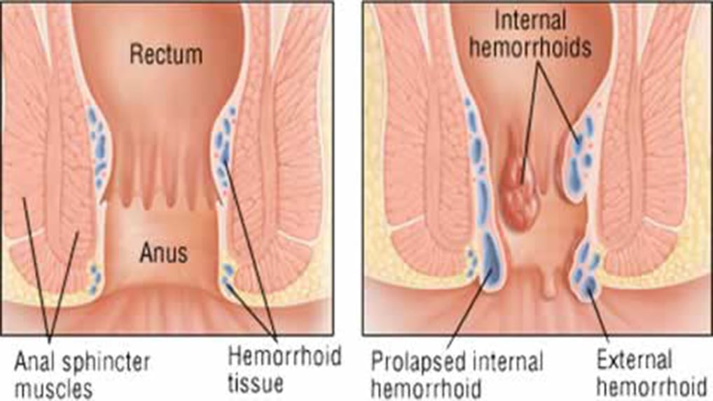 Illustrated internal view of a healthy anus and one with hemorrhoids
