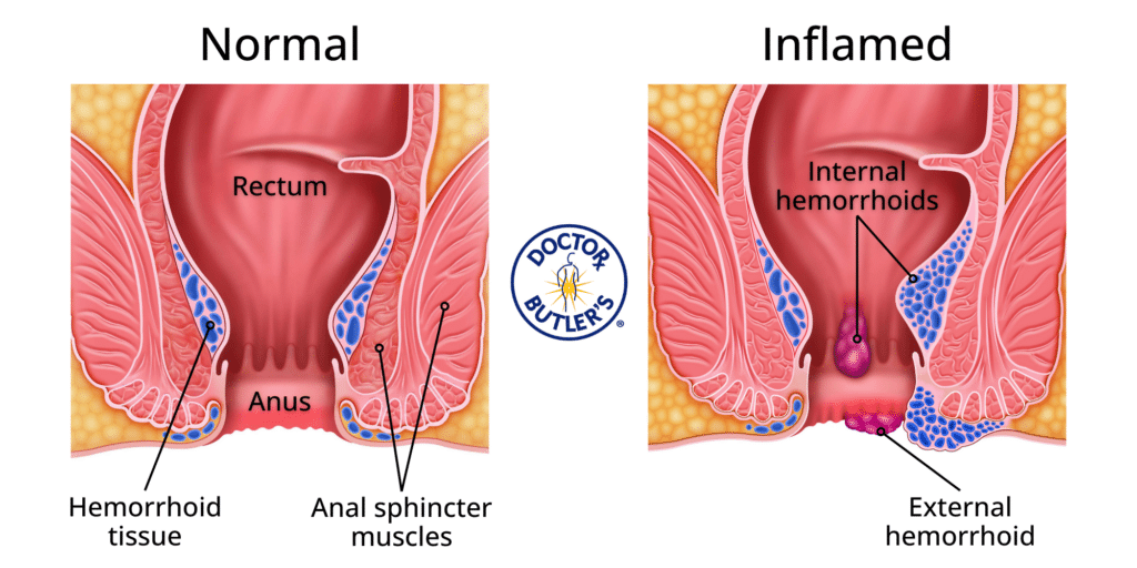 The 6 Best Exercises for Hemorrhoids Prevention & Treatment